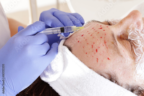 Mezoterapia igłowa twarzy 