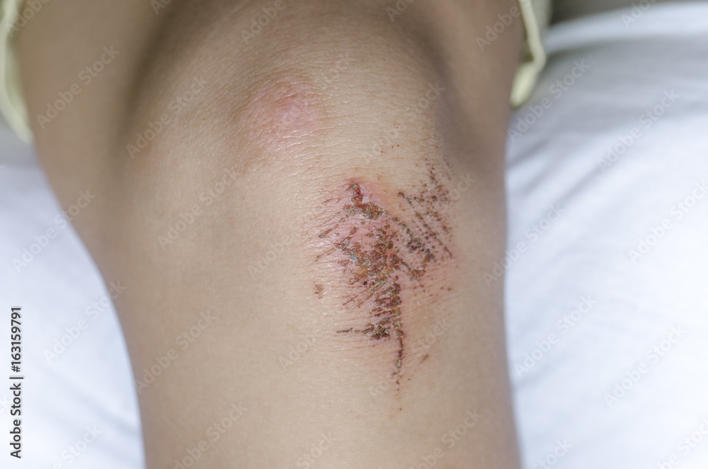 Child hurt his knee, an abrasion on the pavement Child hurt his knee, an abrasion on the pavement