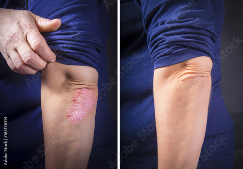 Psoriasis on elbow before and after