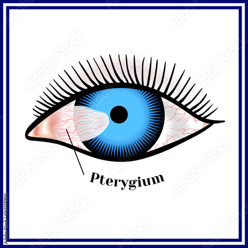 Pterygium. Spreading of the conjunctiva of the eye on the cornea. photo