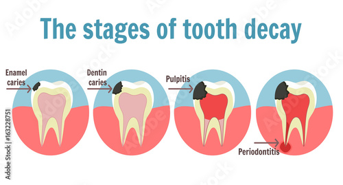 The stages of tooth decay infographic. Dental toothache symbol. Illustration of tooth with caries, pulpitis and periodontitis