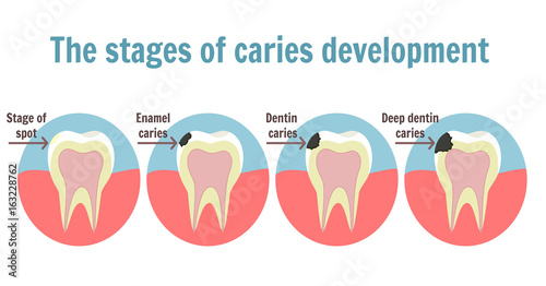 The stages of caries development. Dental toothache symbol. Illustration of tooth with spot, enamel caries, dentin caries and deep dentine caries