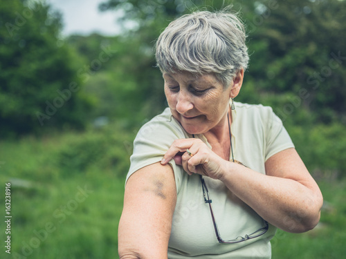 Senior woman with bruise on her arm photo