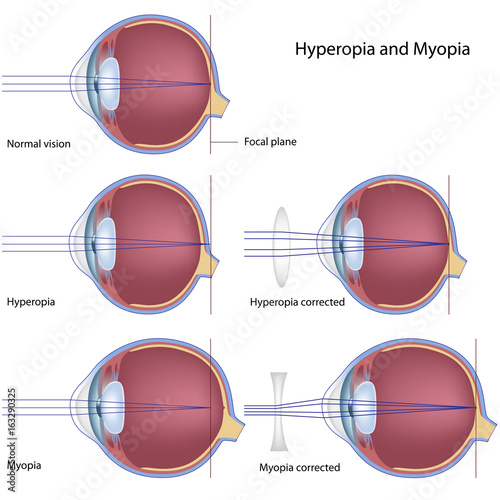 Myopia and hyperopia photo