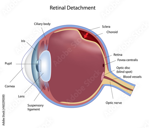 Eye retinal detachment