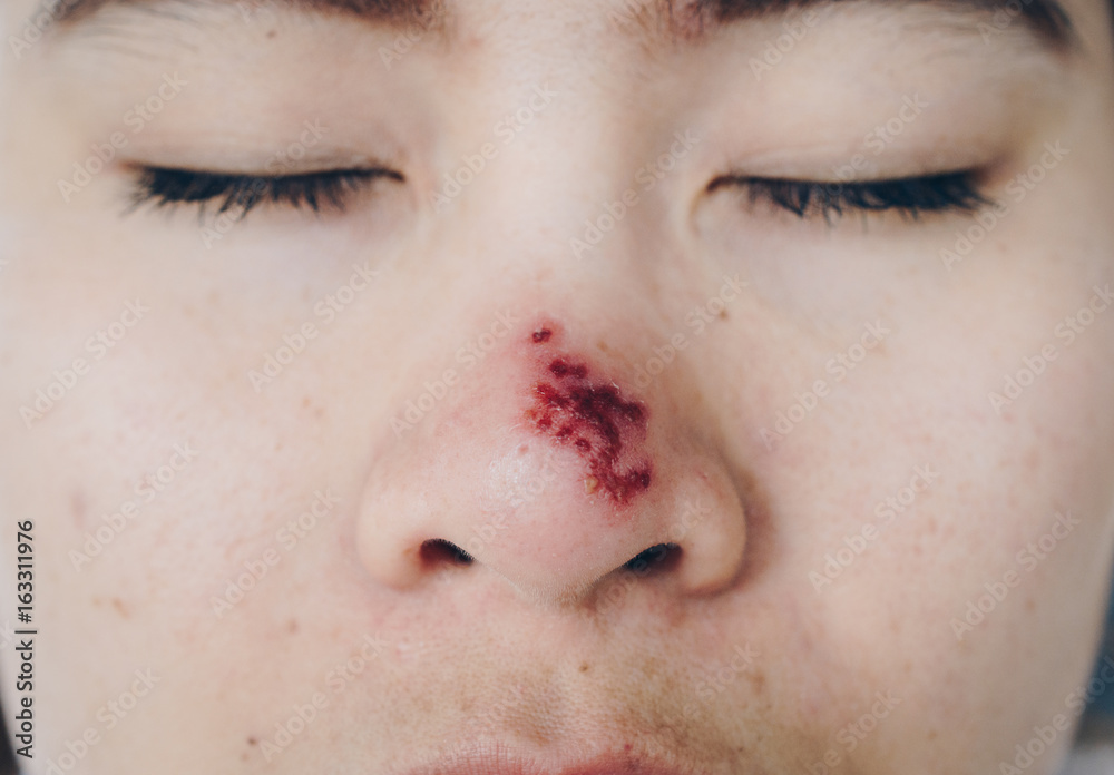 the-herpes-simplex-on-asian-woman-nose-herpes-simplex-is-a-viral
