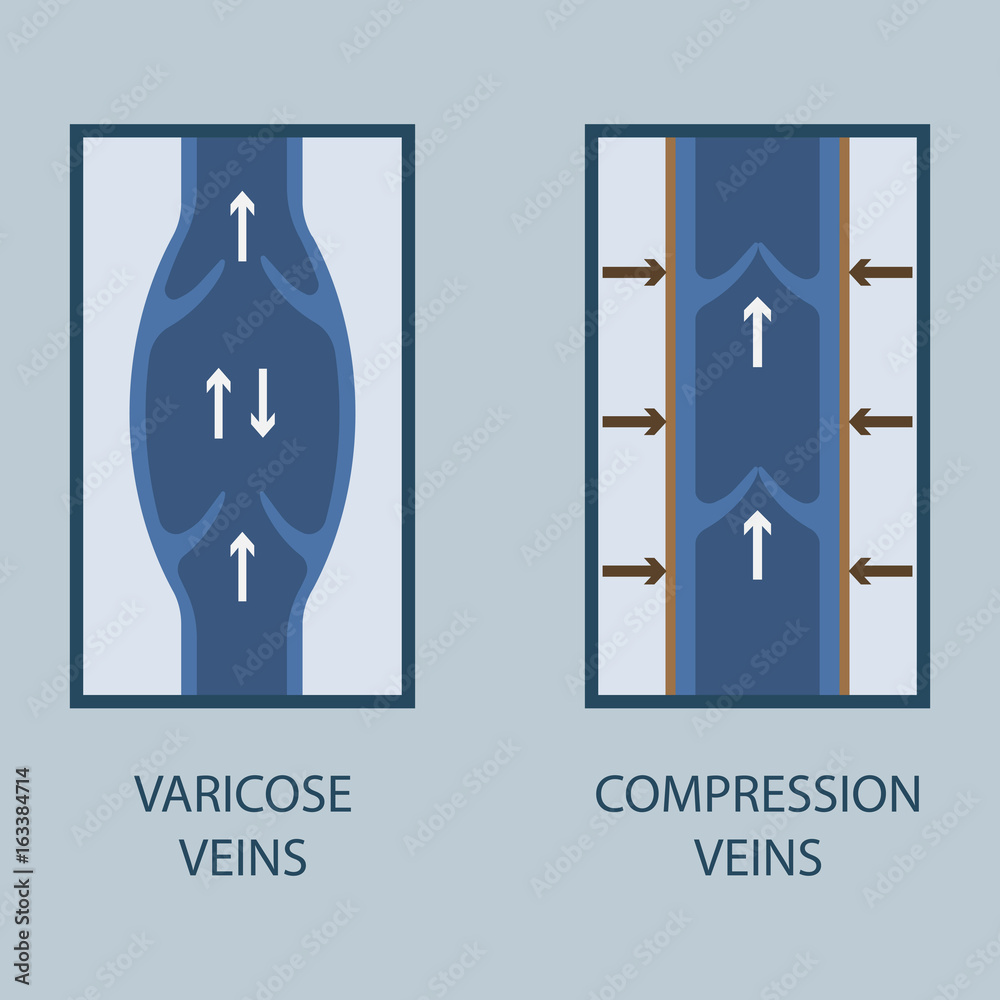 Fototapeta premium Vector illustration of a varicose vein and compression vein. Flat style.