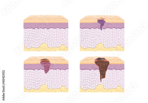 Layer of normal Skin and Spreading of Cancer Cell in vector style in collection. Illustration about medical and health.