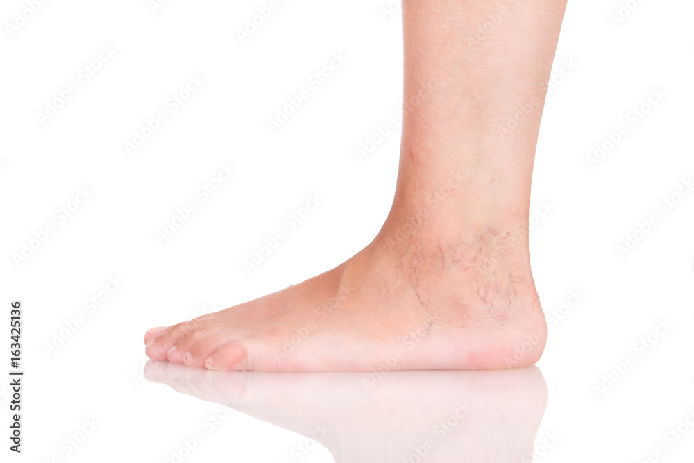 Varicose on the foot. Stop with varicose on a white background Varicose on the foot. Stop with varicose on a white background