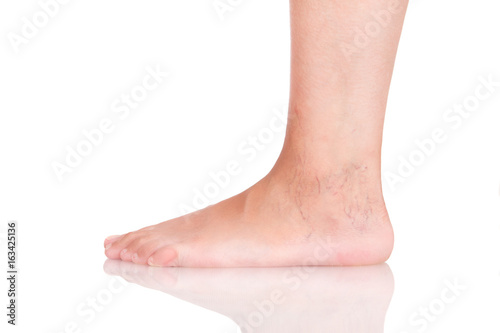 Varicose on the foot. Stop with varicose on a white background