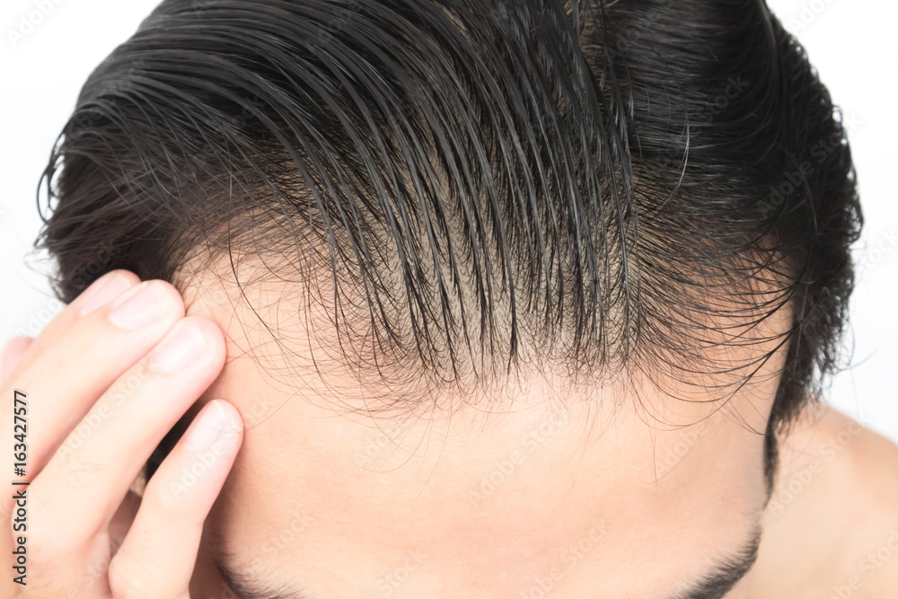 Young man serious hair loss problem for health care shampoo and beauty product concept Young man serious hair loss problem for health care shampoo and beauty product concept