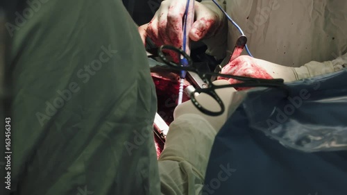 Operation. Heart surgery. Surgery.