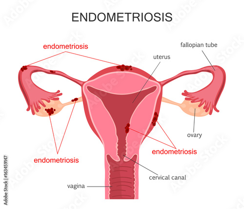 Uterus Endometriosis Diagram photo