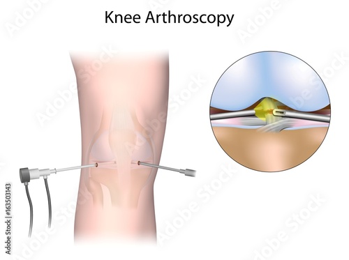 Knee arthroscopy photo