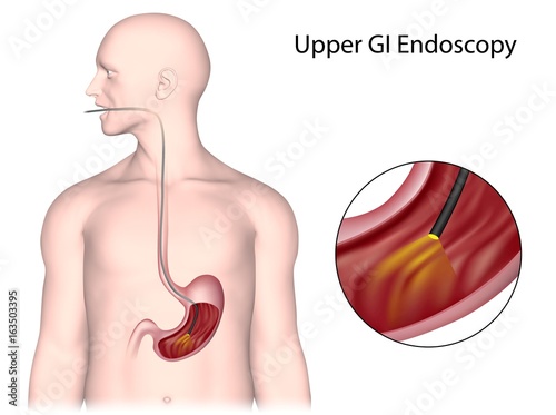 Upper GI endoscopy