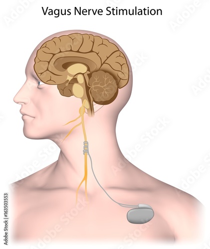 Vagus nerve stimulation therapy as treatment for epilepsy, weight loss,... 