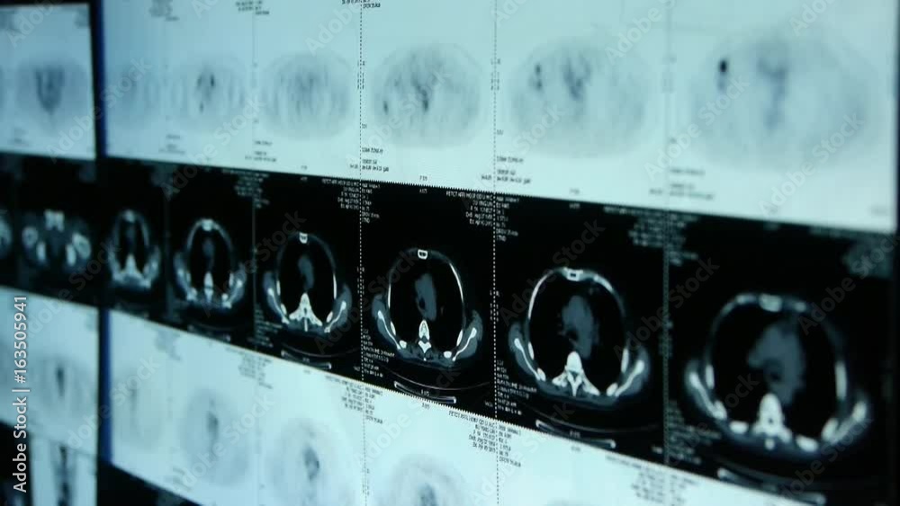 human orage pet-ct scan,medical X-ray,Cancer metastasis. human orage pet-ct scan,medical X-ray,Cancer metastasis.
