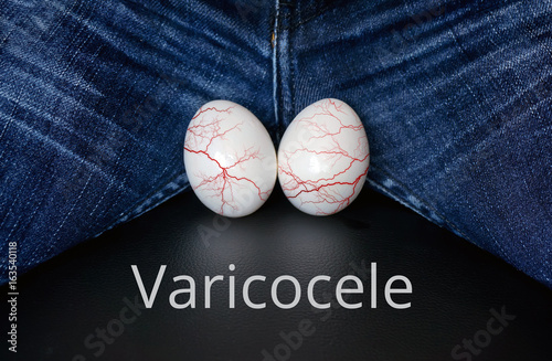 фотографія varicocele - male disease leading to infertility in men