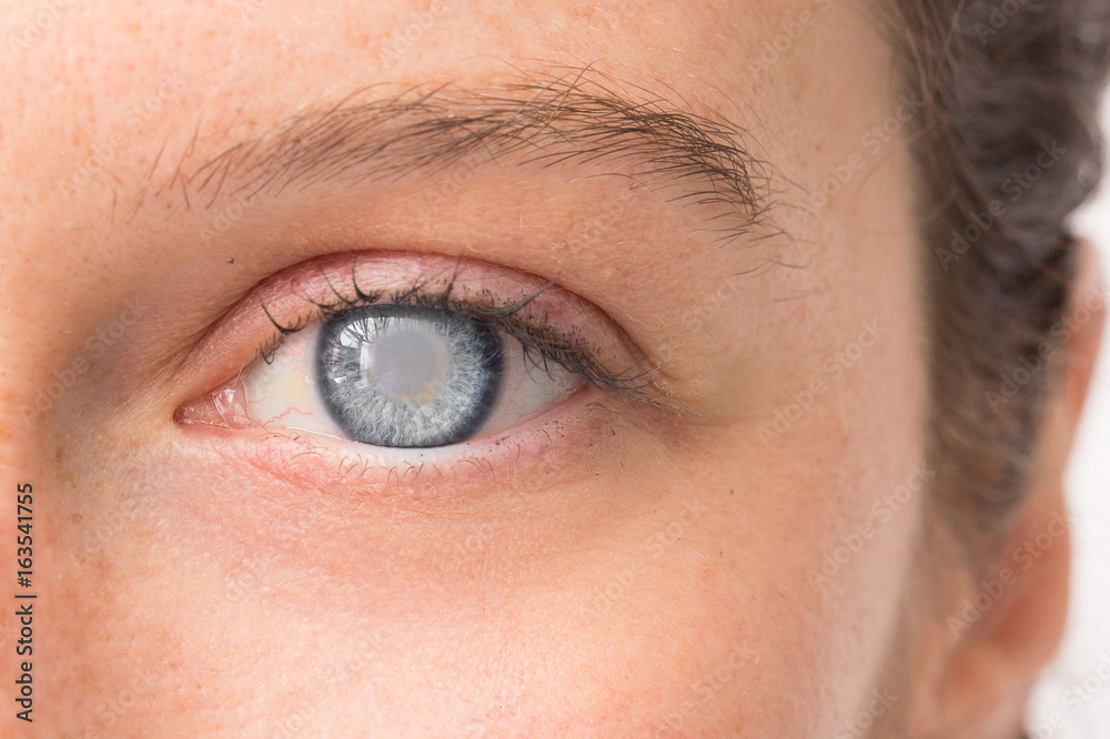 Eye of young girl with corneal opacity Eye of young girl with corneal opacity