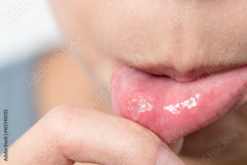 Woman suffer from aphthous stomatitis photo