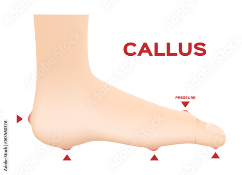 Callus Ischemic and neuropathic Diabetic Foot skin vector
