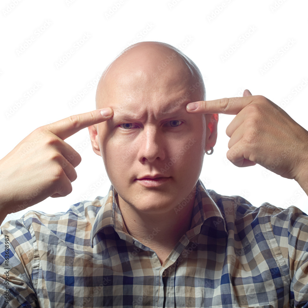 Autoimmune total alopecia men portrait. Absolute bald head without ...