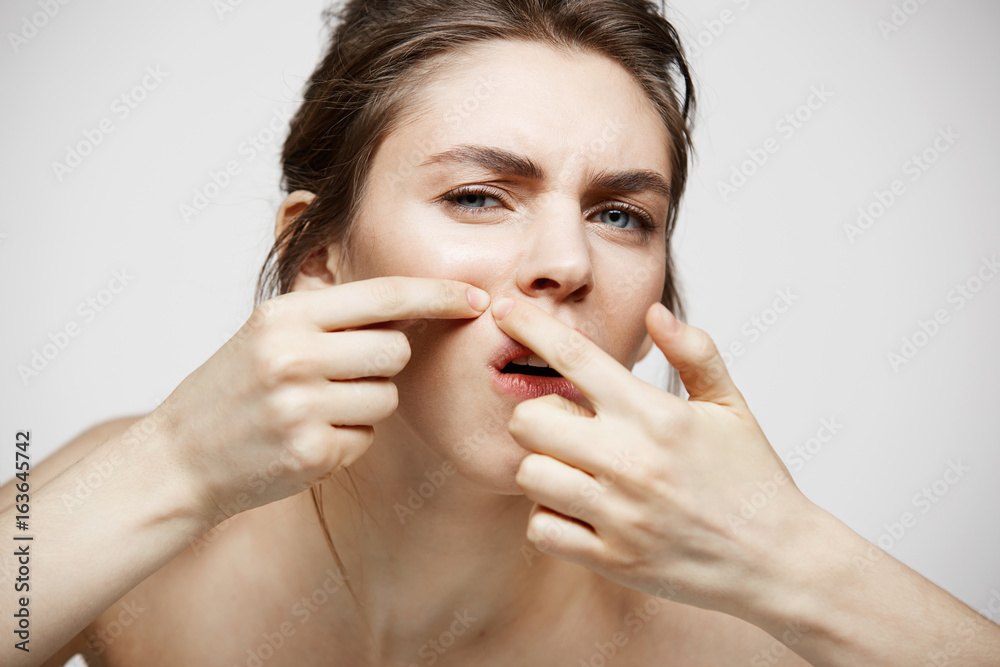 Young brunette girl displeased of her problem acne face skin over white background. Health cosmetology and skincare. Young brunette girl displeased of her problem acne face skin over white background. Health cosmetology and skincare.