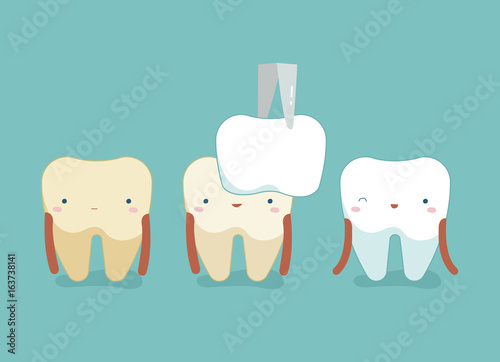 Dental Veneers ,teeth and tooth concept of dental