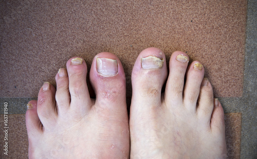 onychomycosis with fungal nail infection two feet photo