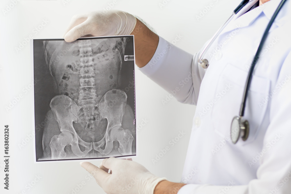 Xray image of LS spine, AP view, show ankylosing spondylitis lumbar