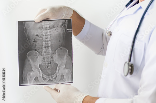 Foto X-ray image of LS spine, AP view, show ankylosing spondylitis lumbar ,Doctor examining a lung radiography, Doctor looking chest x-ray film,Anatomy