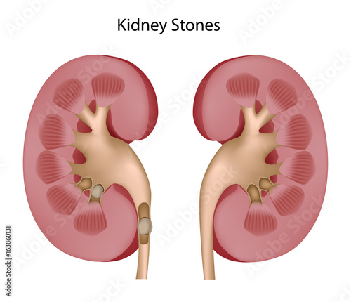 Healthy kidney and kidney with stones photo