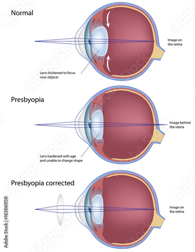 Eye condition: presbyopia photo