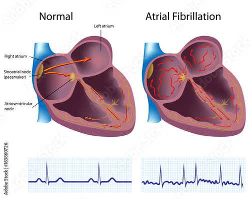Atrial fibrillation - Afib or AF, conduction abnormality with ECG