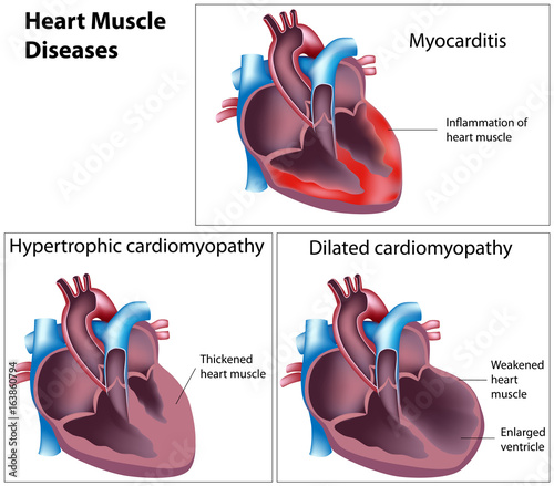 Diseases of heart muscle photo