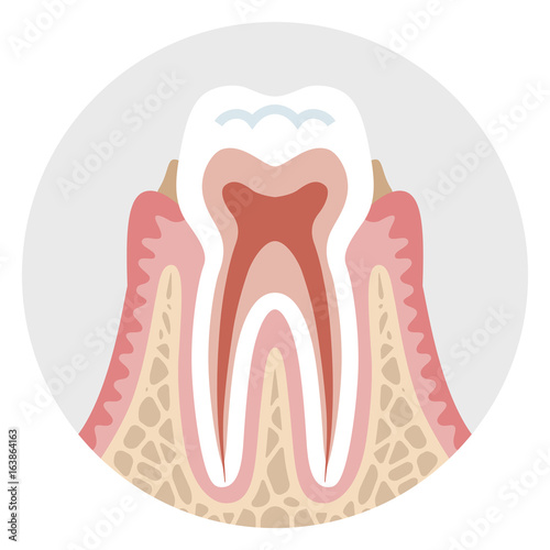Early stage Periodontal disease - Tooth cross section