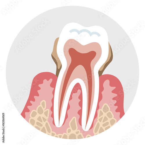 Heavy stage Periodontal disease - Tooth cross section