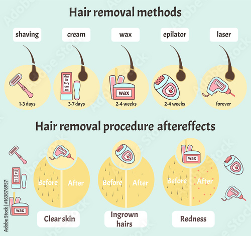 Big flat colorful vector hair removal infographic with epilation and depilation equipment, methods and aftereffects. Beauty salon delicate skin and hair care infographics in blue and pink colors