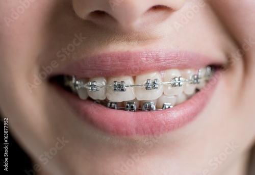 Close-up shot of teeth with braces. Smiling female patient with metal brackets at the dental office. Orthodontic Treatment