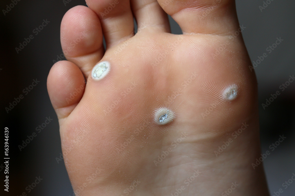 Warts on the leg . Warts on the leg .