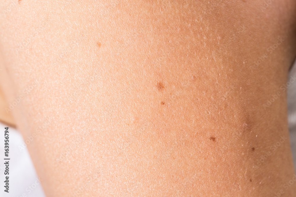 Details and moles on young woman skin