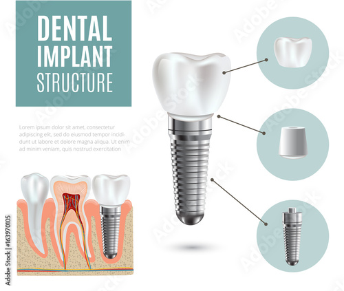 Dental implant structure medical pictorial educative infographic poster