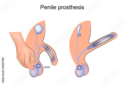 penile prosthesis. urology photo