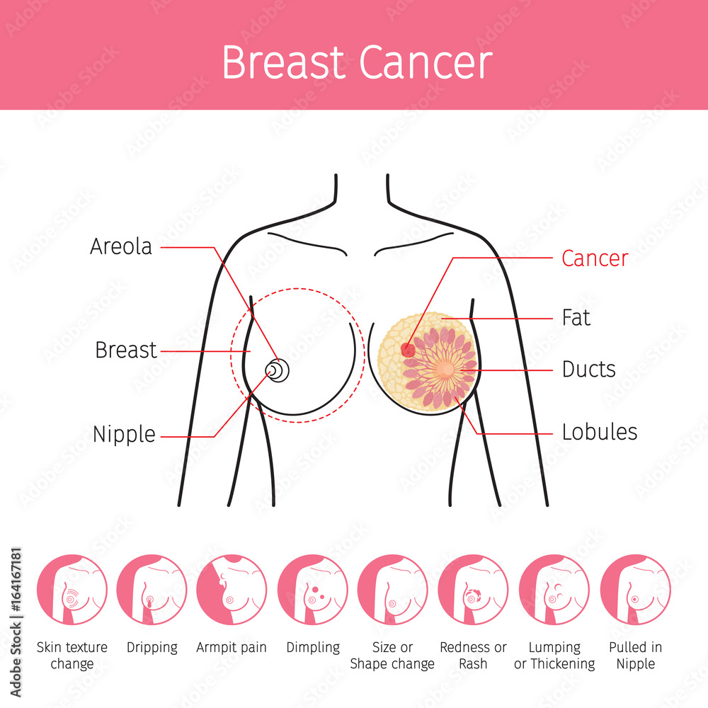 Illustration Of Female Human Breast, Outline And Breast Cancer Symptom  Icons, Mammary, Boob, Body, Organs, Physical, Sickness, Health Stock Vector