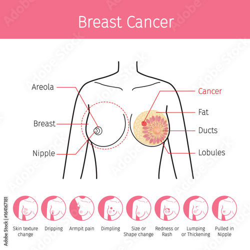 Illustration Of Female Human Breast, Outline And Breast Cancer
