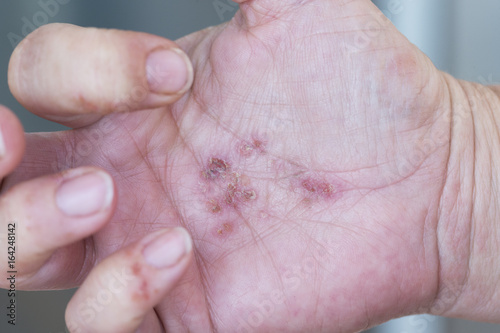 Dermatitis in hands