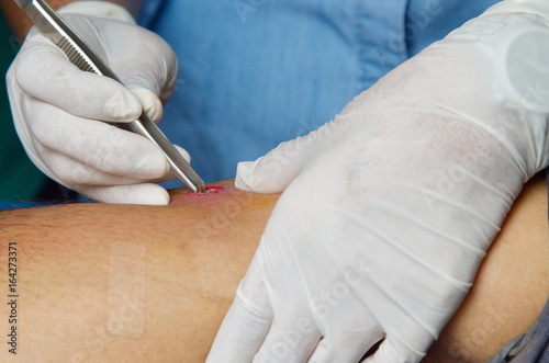 Photos Nurse was drainage pus abscess.