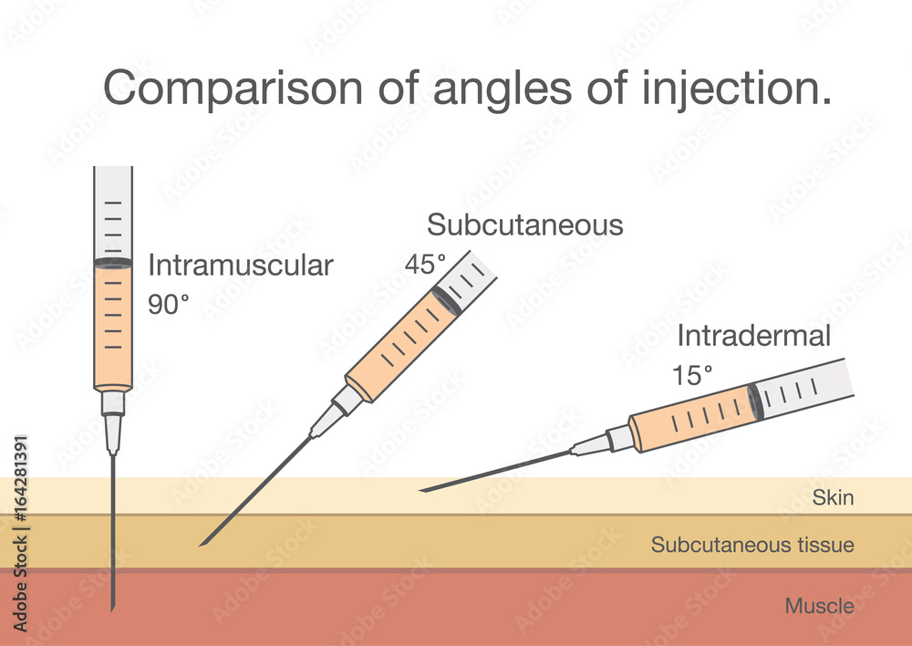 Comparison of the angles of intramuscular injection. Ideal for medical ...
