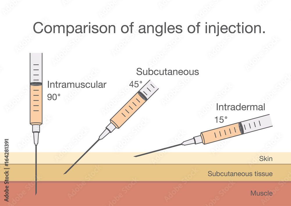 Comparison of the angles of intramuscular injection. Ideal for medical