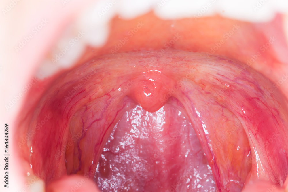 Fototapeta premium tonsilitis infection throat.macro opened mouth throat tonsil